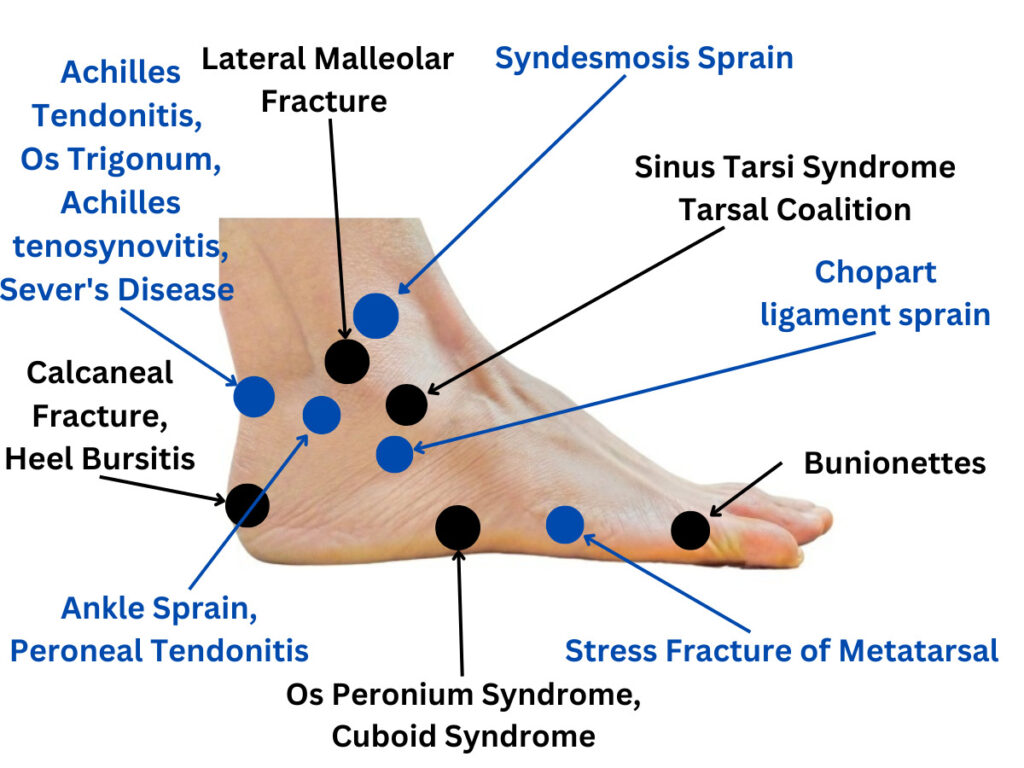 Outer Side Foot Pain Chart