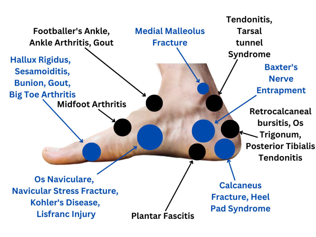 Inner Side Foot Pain Chart