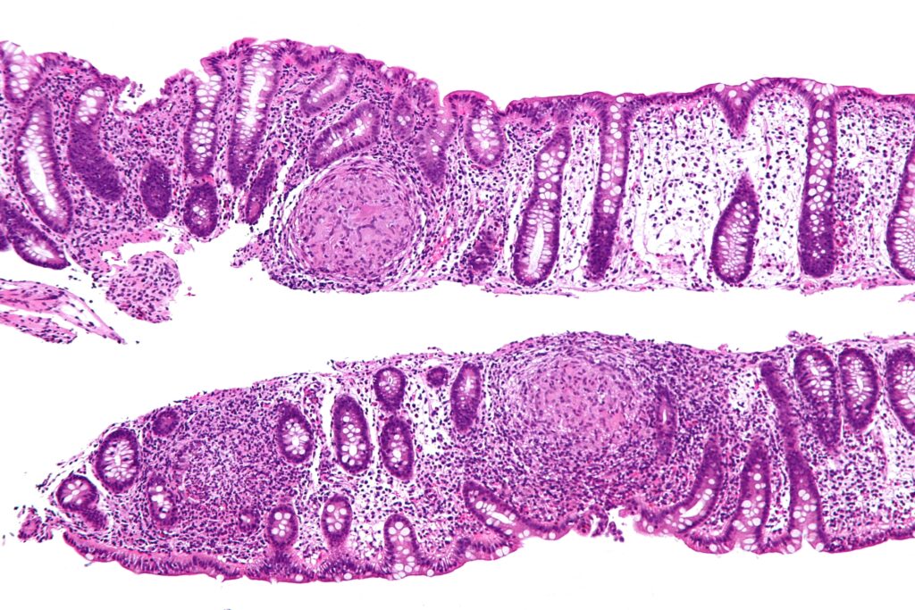 can you take ozempic with crohn's disease