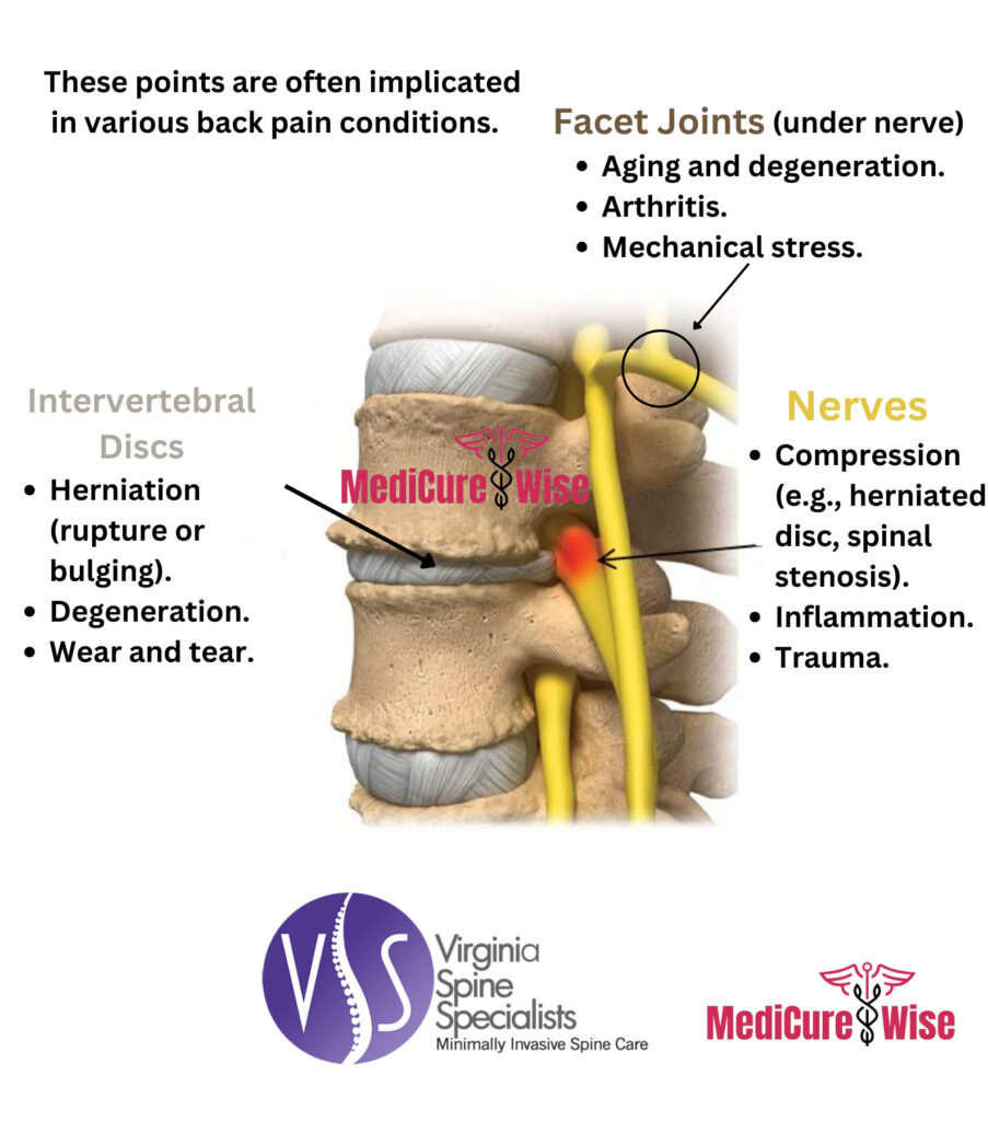 Back Pain Chart - Points in Spine